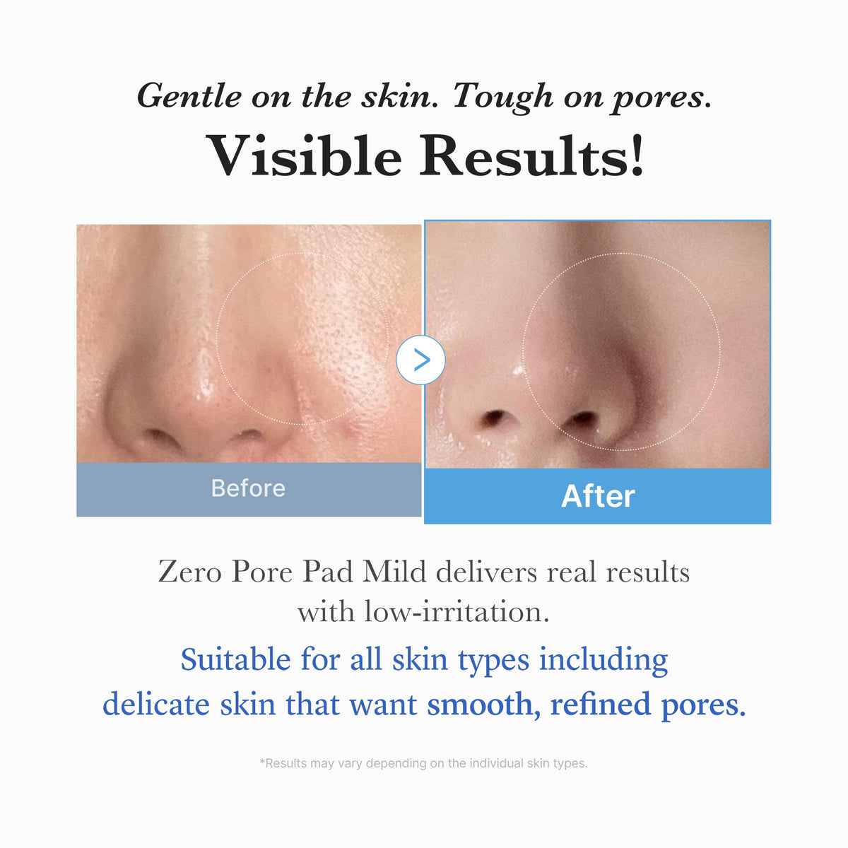 zero-pore-madecassoside-pads-mild-e4 04_6357f9f9-483b-4891-82c6-a58d336e62c8.jpg
